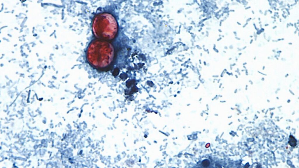 ciclosporiasis,-la-diarrea-mortal:-michigan-reporta-las-primeras-dos-muertes-en-eeuu-por-el-parasito